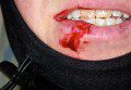 Cut Lip