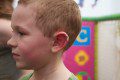 Ear Injury