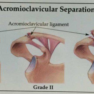 Acromioclavicular Ligament Tear