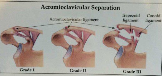 Acromioclavicular Ligament Tear