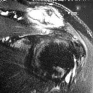 AC Joint Arthritis