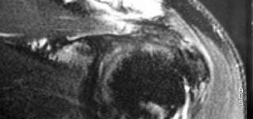 AC Joint Arthritis
