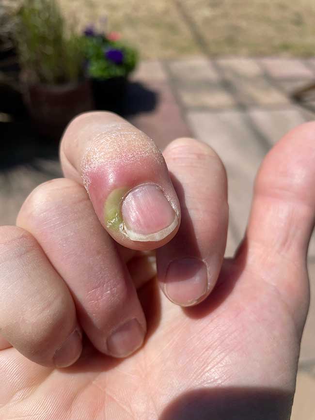 Sore Finger